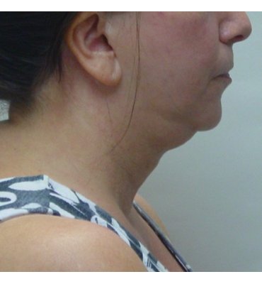 excess fat in neck